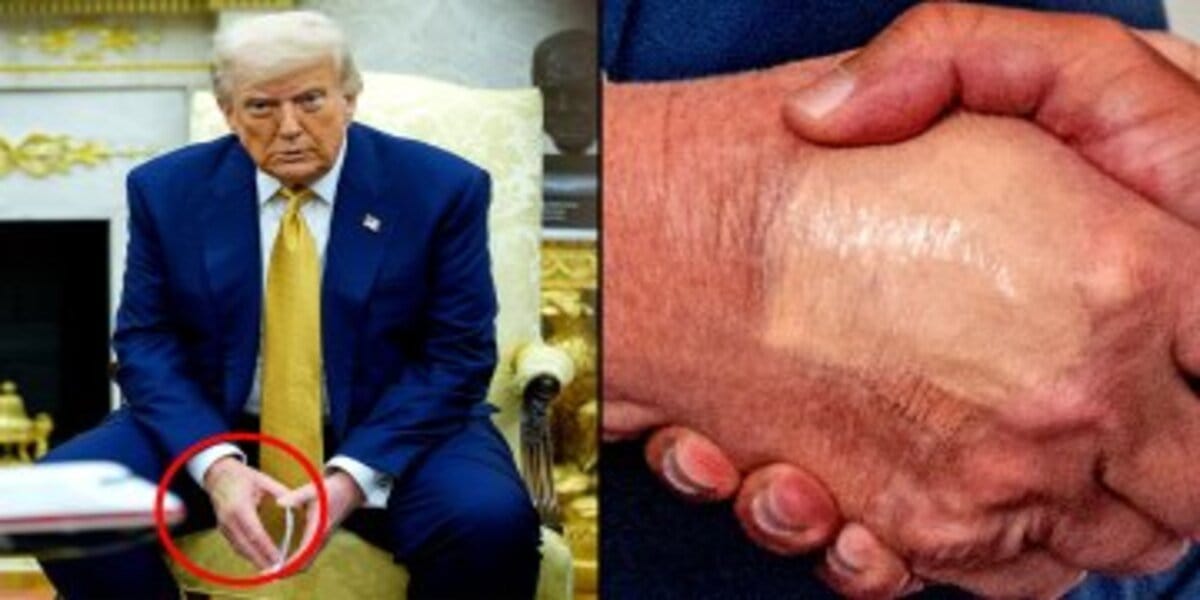 Trump's legs are swollen and his hands bruised, says White House