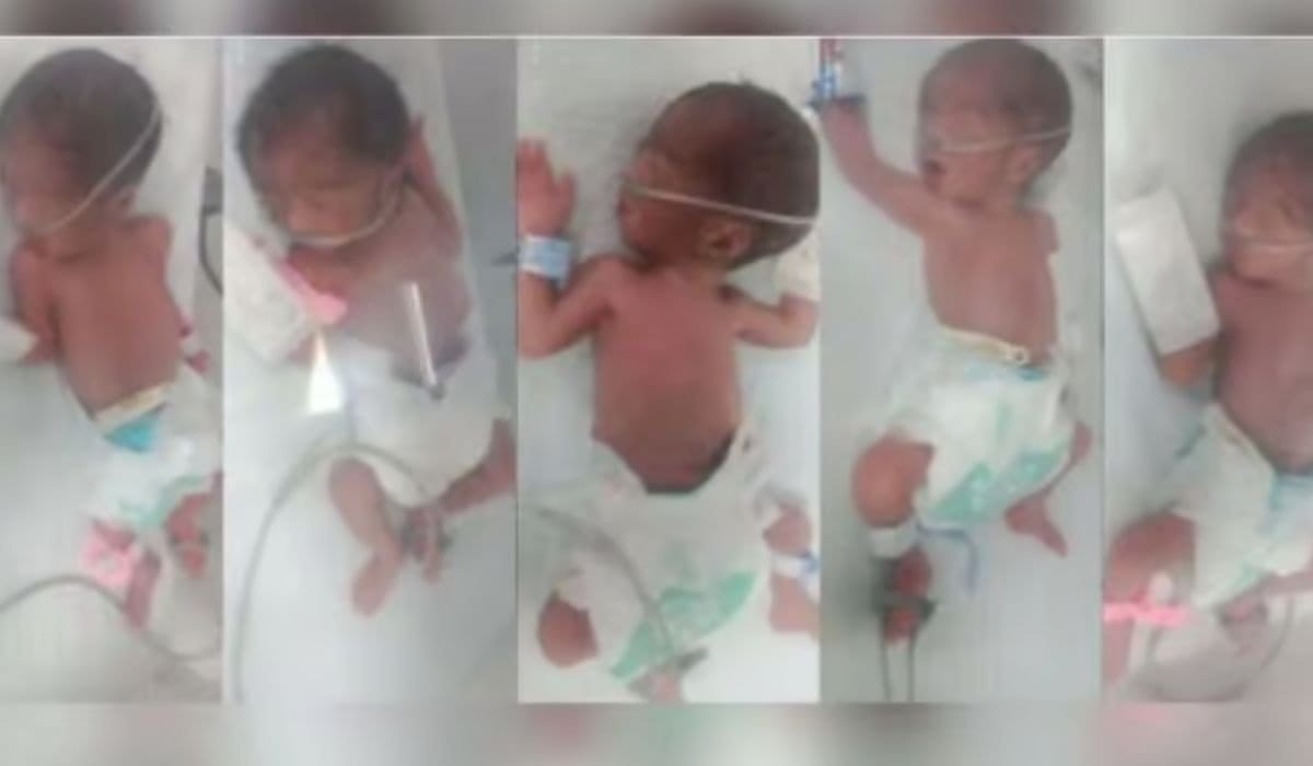 Karachi Hospital Treats Rare Case of Quintuple Birth