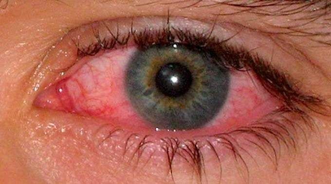 Guidelines for Pink Eye Infection"