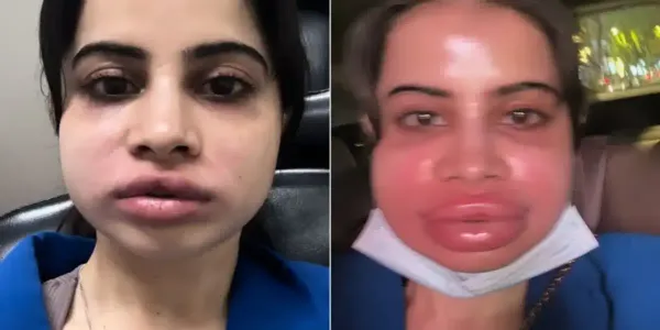 Urfi Javed Goes Viral After Dissolving Lip Fillers: “This is Not a Filter”