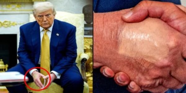 Trump's legs are swollen and his hands bruised, says White House