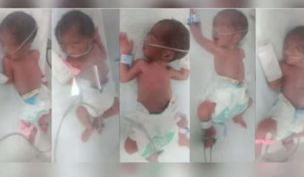 Karachi Hospital Treats Rare Case of Quintuple Birth