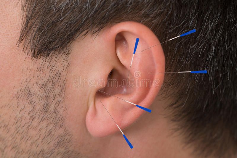 Acupuncture needles on ear stock photo Image of accuracy