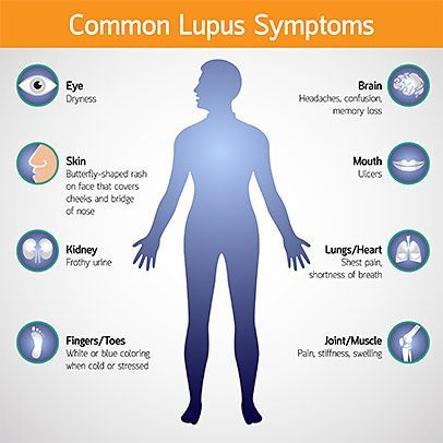 Signs and Symptoms of Lupus