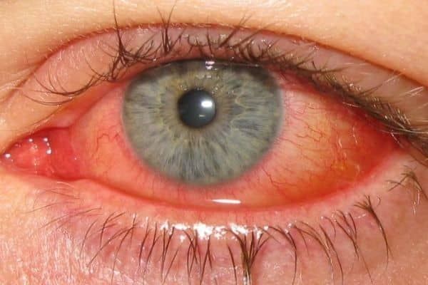Pink Eye Outbreak